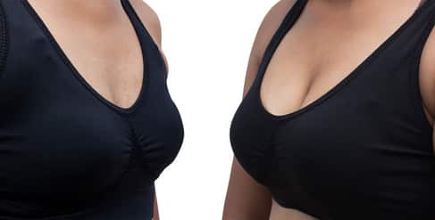 כמה עולה הגדלת חזה