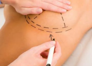 סיליקון או שומן עצמי: מה באמת עדיף בניתוחים להגדלת חזה?