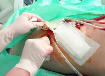 הגדלת חזה מעל השריר