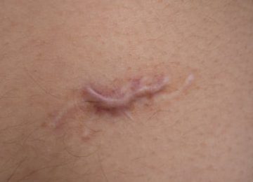 האם ניתן לבצע ניתוח להרמת חזה ללא צלקות?