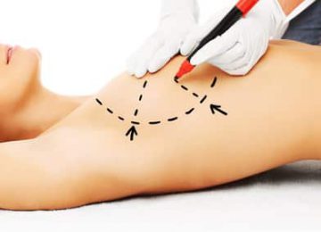 ניתוח הגדלת חזה ללא שתלים